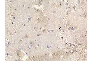 ABIN6266299 and ABIN6277447 at 1/100 staining human glioblastoma by IHC-P. (Neurogenin 1 anticorps  (Internal Region))