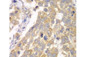 Immunohistochemistry of paraffin-embedded Human esophageal cancer using PFKM Polyclonal Antibody at dilution of 1:100 (40x lens). (PFKM anticorps)