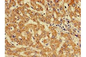Immunohistochemistry of paraffin-embedded human liver cancer using ABIN7157603 at dilution of 1:100 (KIF17 anticorps  (AA 500-777))