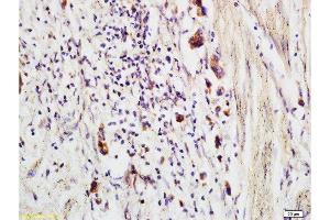 Formalin-fixed and paraffin embedded human colon carcinoma labeled with Anti-CCP Polyclonal Antibody, Unconjugated  at 1:200 followed by conjugation to the secondary antibody and DAB staining (CRYGD anticorps)