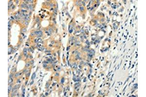 The image on the left is immunohistochemistry of paraffin-embedded Human colon cancer tissue using ABIN7130917(RPAP3 Antibody) at dilution 1/15, on the right is treated with fusion protein. (RPAP3 anticorps)