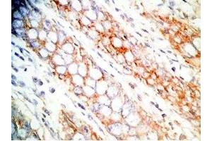 Human colon cancer tissue was stained by Rabbit Anti-CCK-33  (Human,Rat) Antibody (Cholecystokinin anticorps)