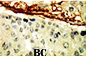 Formalin-fixed and paraffin-embedded human cancer tissue reacted with EPHA4 polyclonal antibody  , which was peroxidase-conjugated to the secondary antibody, followed by DAB staining. (EPH Receptor A4 anticorps  (AA 40-70))