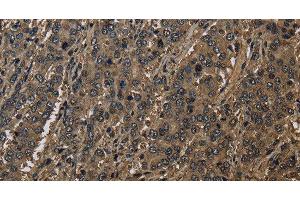 Immunohistochemistry of paraffin-embedded Human liver cancer using GSTO1 Polyclonal Antibody at dilution of 1:60 (GSTO1 anticorps)
