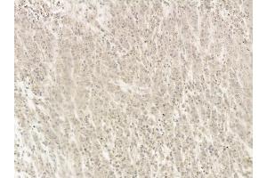 p53 Mouse Monoclonal Antibody at 1/100 staining human gastric cancer and adjacent non-tumor tissue by IHC-P. (p53 anticorps  (Internal Region))