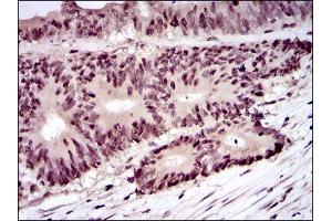 Immunohistochemical analysis of paraffin-embedded colon cancer tissues using PCNA mouse mAb with DAB staining.