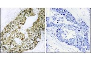 Immunohistochemistry analysis of paraffin-embedded human breast carcinoma tissue, using IkappaB-alpha (Ab-42) Antibody. (NFKBIA anticorps  (AA 9-58))