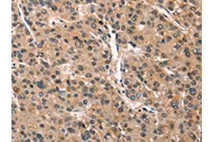 The image on the left is immunohistochemistry of paraffin-embedded Human liver cancer tissue using ABIN7190351(CRIM1 Antibody) at dilution 1/25, on the right is treated with synthetic peptide.