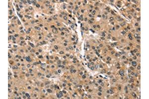 The image on the left is immunohistochemistry of paraffin-embedded Human liver cancer tissue using ABIN7190351(CRIM1 Antibody) at dilution 1/25, on the right is treated with synthetic peptide. (CRIM1 anticorps)