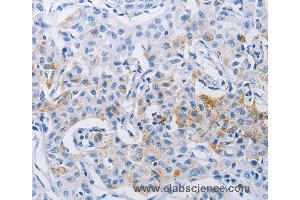 Immunohistochemistry of Human lung cancer using LRIG1 Polyclonal Antibody at dilution of 1:120 (Lrig1 anticorps)