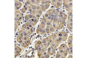 Immunohistochemical analysis of GPx-4 staining in human liver cancer formalin fixed paraffin embedded tissue section. (GPX4 anticorps)