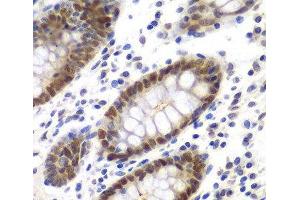 Immunohistochemistry of paraffin-embedded Human colon using MSH6 Polyclonal Antibody at dilution of 1:100 (40x lens). (MSH6 anticorps)