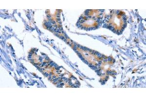 Immunohistochemistry of paraffin-embedded Human colon cancer using IBSP Polyclonal Antibody at dilution of 1:50 (IBSP anticorps)