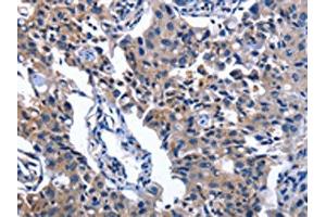 The image on the left is immunohistochemistry of paraffin-embedded Human lung cancer tissue using ABIN7130344(NAT8 Antibody) at dilution 1/50, on the right is treated with fusion protein. (NAT8 anticorps)