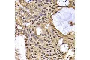 Immunohistochemistry of paraffin-embedded human oophoroma using ARID3A antibody (ABIN5975618) at dilution of 1/100 (40x lens). (ARID3A anticorps)