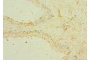 Immunohistochemistry of paraffin-embedded human prostate cancer using ABIN7172868 at dilution of 1:100 (TRPM6 anticorps  (AA 740-840))