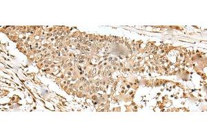 Immunohistochemistry of paraffin-embedded Human colorectal cancer tissue using EEF1E1 Polyclonal Antibody at dilution of 1:35(x200) (EEF1E1 anticorps)