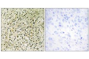 Immunohistochemistry analysis of paraffin-embedded human prostate carcinoma tissue, using RHG07 antibody. (DLC1 anticorps  (N-Term))