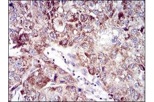 Immunohistochemical analysis of paraffin-embedded liver cancer tissues using UBE2C mouse mAb with DAB staining. (UBE2C anticorps  (AA 1-179))