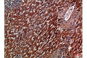 Immunohistochemical analysis of paraffin-embedded Human-liver-cancer, antibody was diluted at 1:100 (CXCR1 anticorps  (AA 1-50))