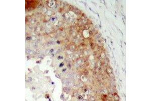 Immunohistochemical analysis of LRRC41 staining in human prostate cancer formalin fixed paraffin embedded tissue section.