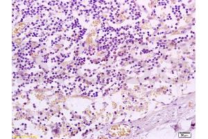 Formalin-fixed and paraffin embedded human colon carcinoma tissue labeled with Anti-PAR-2 Polyclonal Antibody, Unconjugated (ABIN738816) at 1:200 followed by conjugation to the secondary antibody and DAB staining