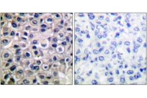 Immunohistochemistry analysis of paraffin-embedded human breast carcinoma tissue, using MMP-14 Antibody. (MMP14 anticorps  (AA 471-520))