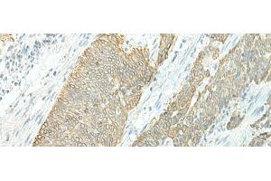 Immunohistochemistry of paraffin-embedded Human esophagus cancer tissue using ETAA1 Polyclonal Antibody at dilution of 1:25(x200) (ETAA1 anticorps)