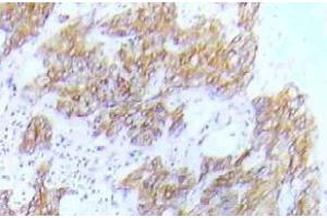 Immunohistochemistry (IHC) analyzes of p-FLT3 antibody in paraffin-embedded human lung adenocarcinoma tissue. (FLT3 anticorps  (pTyr591))