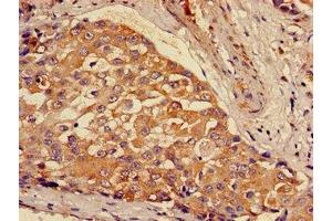Immunohistochemistry of paraffin-embedded human breast cancer using ABIN7154002 at dilution of 1:100 (GCLM anticorps  (Regulatory Subunit))