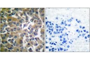 Immunohistochemistry analysis of paraffin-embedded human breast carcinoma tissue, using FAP-1 Antibody. (FAP anticorps  (AA 331-380))