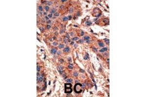 Formalin-fixed and paraffin-embedded human cancer tissue reacted with the primary antibody, which was peroxidase-conjugated to the secondary antibody, followed by AEC staining.