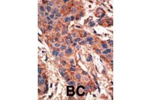 Formalin-fixed and paraffin-embedded human cancer tissue reacted with the primary antibody, which was peroxidase-conjugated to the secondary antibody, followed by AEC staining. (BMPR1A anticorps  (N-Term))
