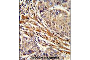 Formalin-fixed and paraffin-embedded human hepatocarcinoma reacted with APRT Antibody , which was peroxidase-conjugated to the secondary antibody, followed by DAB staining. (APRT anticorps  (C-Term))