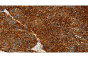 Immunohistochemistry of paraffin-embedded Human liver cancer using ASGR1 Polyclonal Antibody at dilution of 1:50 (Asialoglycoprotein Receptor 1 anticorps)