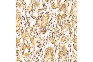 Immunohistochemistry of paraffin-embedded Human gastric using BSG antibody at dilution of 1:100 (x400 lens).
