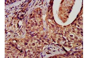Immunohistochemistry analysis of human cervical cancer using ABIN7150829 at dilution of 1:100 (Dynamin 1-Like anticorps  (AA 496-710))