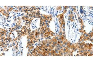 Immunohistochemistry of paraffin-embedded Human lung cancer using CKAP4 Polyclonal Antibody at dilution of 1:50 (CKAP4 anticorps)