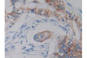 Detection of DCLK1 in Human Bile duct cancer Tissue using Polyclonal Antibody to Doublecortin Like Kinase 1 (DCLK1)