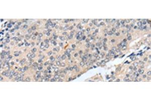 Immunohistochemistry of paraffin-embedded Human prost at e cancer tissue using MOB1B Polyclonal Antibody at dilution of 1:25(x200) (MOBKL1A anticorps)