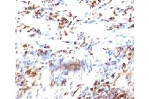 Formalin-fixed, paraffin-embedded human colon carcinoma stained with p27Kip1 antibody (KIP1/769) (CDKN1B anticorps)