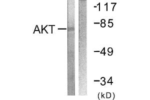 Immunohistochemistry analysis of paraffin-embedded human breast carcinoma tissue using Akt (Ab-326) antibody. (AKT1 anticorps)
