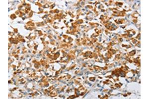 The image on the left is immunohistochemistry of paraffin-embedded Human thyroid cancer tissue using ABIN7128507(ARHGEF9 Antibody) at dilution 1/50, on the right is treated with fusion protein. (Arhgef9 anticorps)