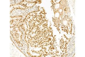 ABIN6261149 and ABIN6266524 at 1/100 staining Human lung cancer by IHC-P.