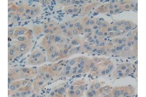 Detection of IFNa/bR1 in Human Liver cancer Tissue using Polyclonal Antibody to Interferon Alpha/Beta Receptor 1 (IFNa/bR1) (IFNAR1 anticorps  (AA 28-227))