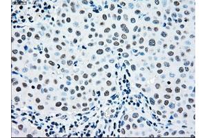 Immunohistochemical staining of paraffin-embedded Adenocarcinoma of ovary tissue using anti-MAP2K2mouse monoclonal antibody. (MEK2 anticorps)