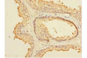 Immunohistochemistry of paraffin-embedded human prostate cancer using ABIN7152099 at dilution of 1:100 (ELF5 anticorps  (AA 1-170))