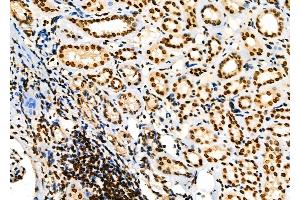 ABIN6258750 and ABIN6274361 at 1/100 staining Human kidney cancer and adjacent normal tissues by IHC-P. (CDK5R1 anticorps  (N-Term))
