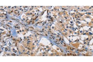 Immunohistochemistry of paraffin-embedded Human thyroid cancer using c-Fos Polyclonal Antibody at dilution of 1:70 (c-FOS anticorps)
