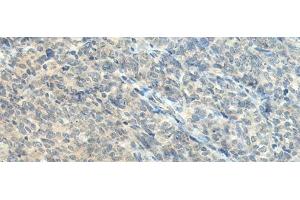 Immunohistochemistry of paraffin-embedded Human ovarian cancer tissue using CTDP1 Polyclonal Antibody at dilution of 1:55(x200) (CTDP1 anticorps)